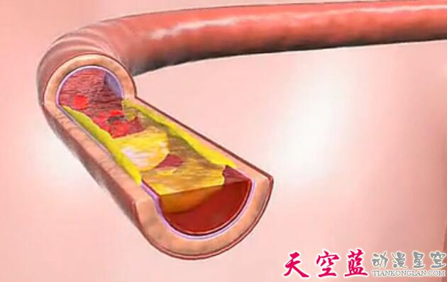 高血压的5个危害医学演示三维3D动画制作.jpg