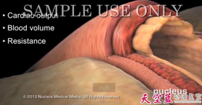 高血压三维3D医学动画制作.jpg
