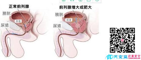 经尿道前列腺等离子双极电切术动画视频d.jpg