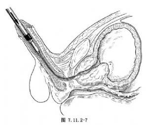 经尿道前列腺切除术
